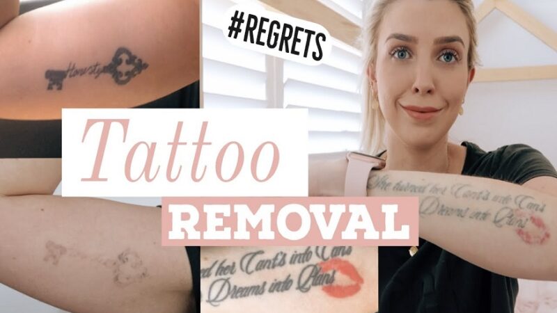 Tattoo Removing