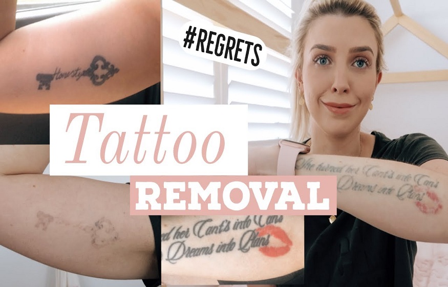 5 Questions You Must Ask a Tattoo Removing Expert